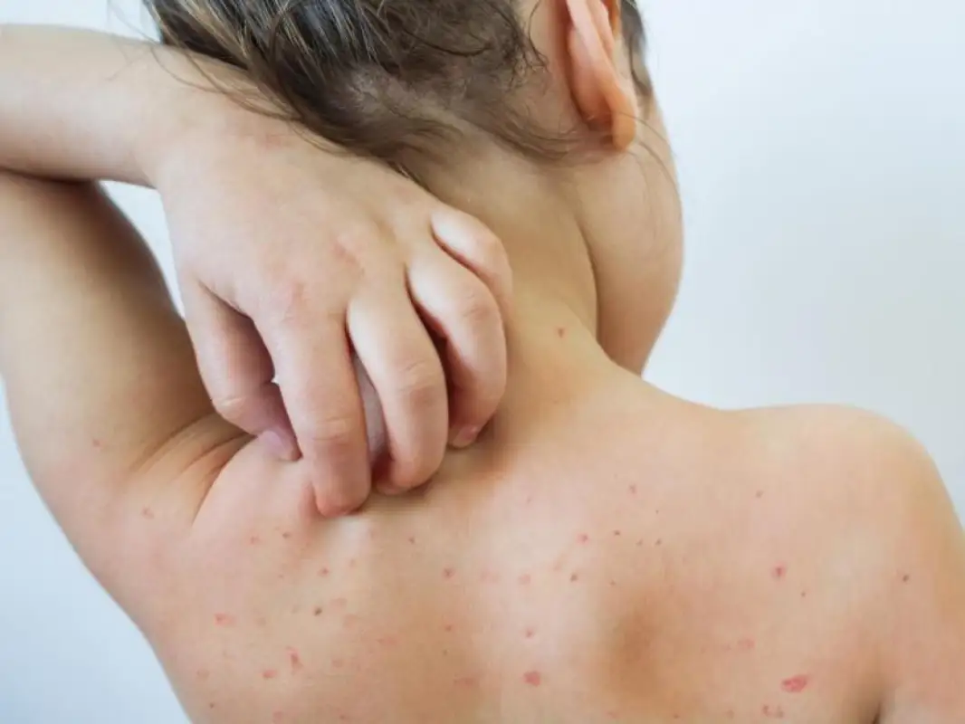 В трех регионах Казахстана уменьшилась заболеваемость корью