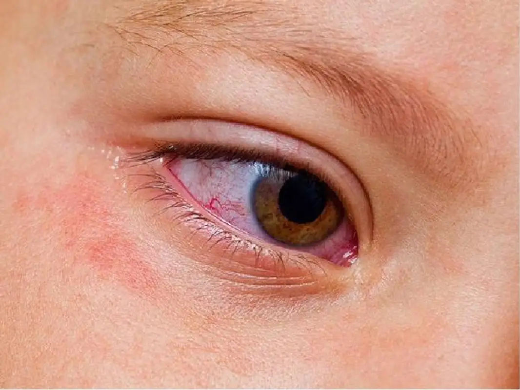 В Казахстане у троих детей выявлен синдром Кавасаки