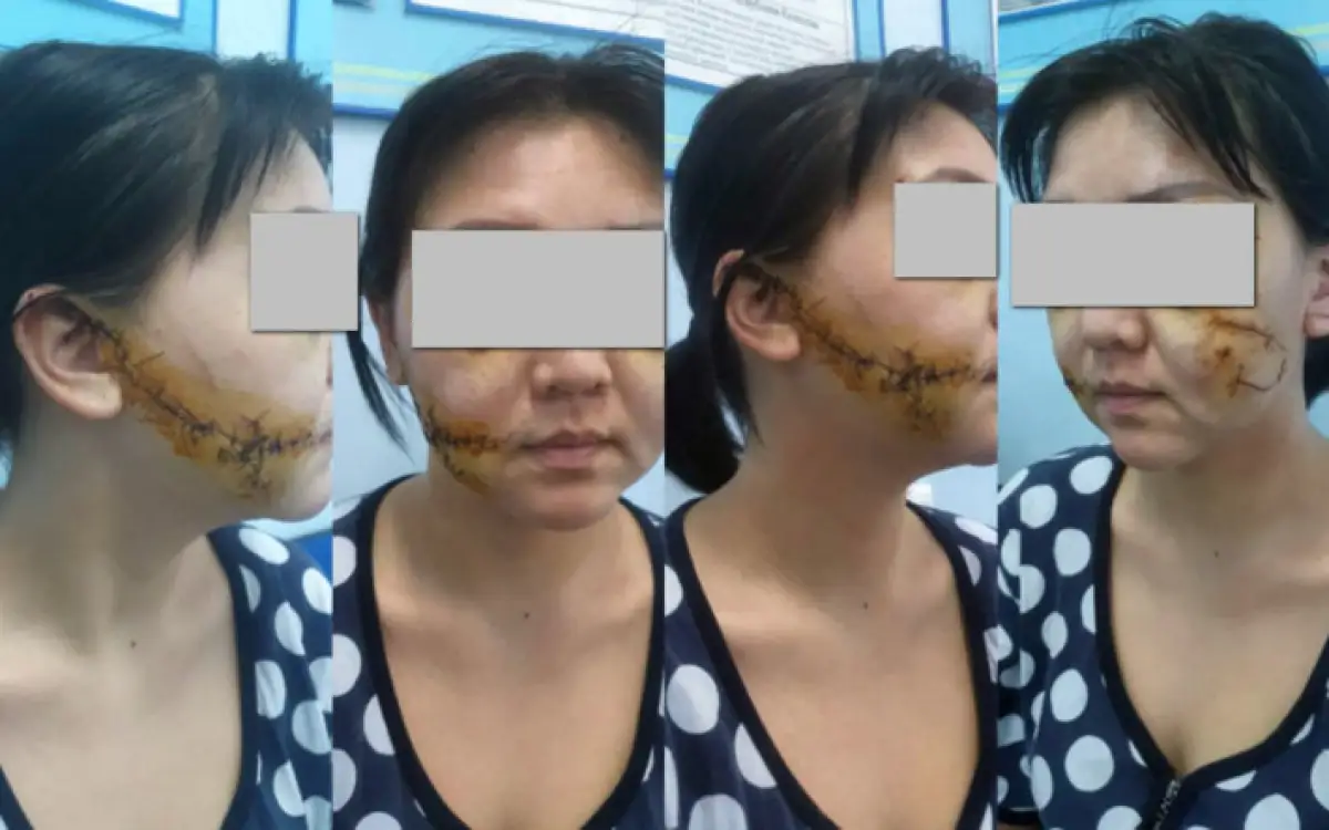 Жительница Актобе простила мужа, изрезавшего ей лицо: суд поступил иначе