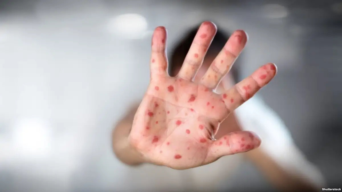 ОРВИ, корь: инфекционные стационары Астаны переполнены заразившимися детьми