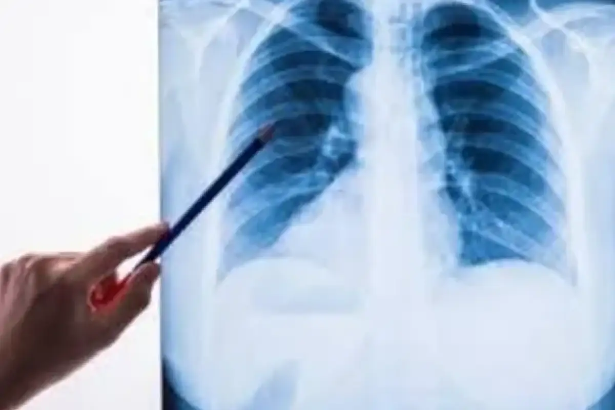 Почему казахстанцев поражает пневмония, хотя сейчас лето и нет холодов