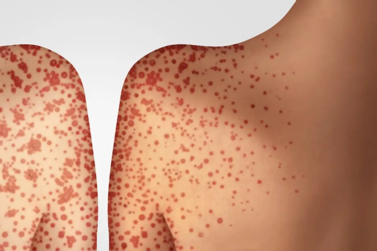 В Казахстан зашли два новых вируса кори, не заболеть невозможно – Бекшин