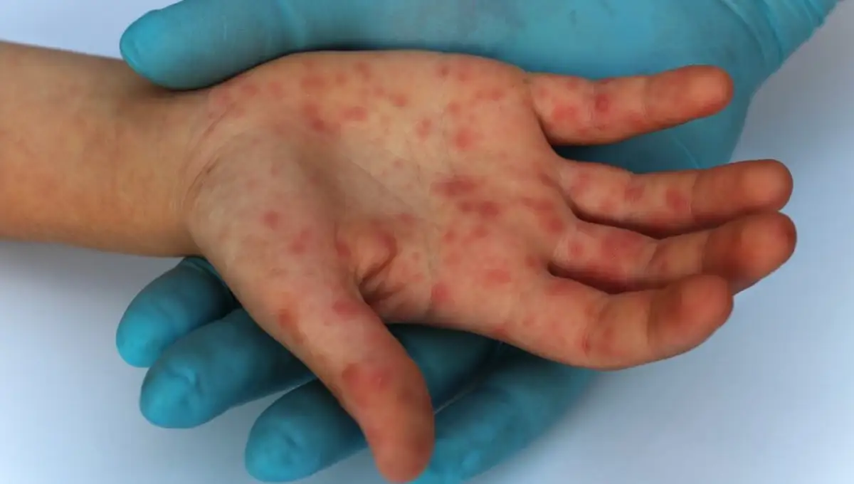 Казахстан занимает первое место по распространению кори в мире – Альназарова