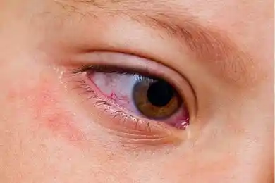 В Казахстане у троих детей выявлен синдром Кавасаки