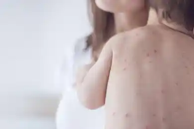 Минздрав не предполагает: объявят ли в Казахстане карантин в связи в вспышкой заболеваемости корью