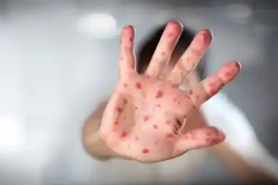 ОРВИ, корь: инфекционные стационары Астаны переполнены заразившимися детьми