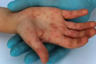 Казахстан занимает первое место по распространению кори в мире – Альназарова