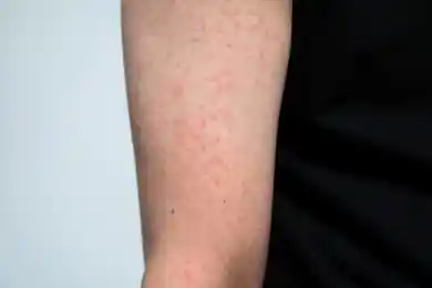 83 процента заболевших корью детей - непривитые