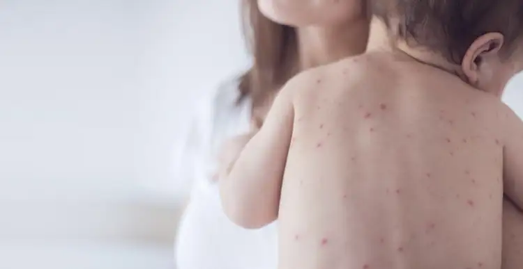 Минздрав не предполагает: объявят ли в Казахстане карантин в связи в вспышкой заболеваемости корью