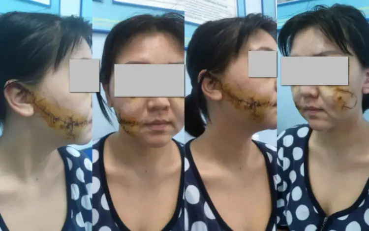 Жительница Актобе простила мужа, изрезавшего ей лицо: суд поступил иначе