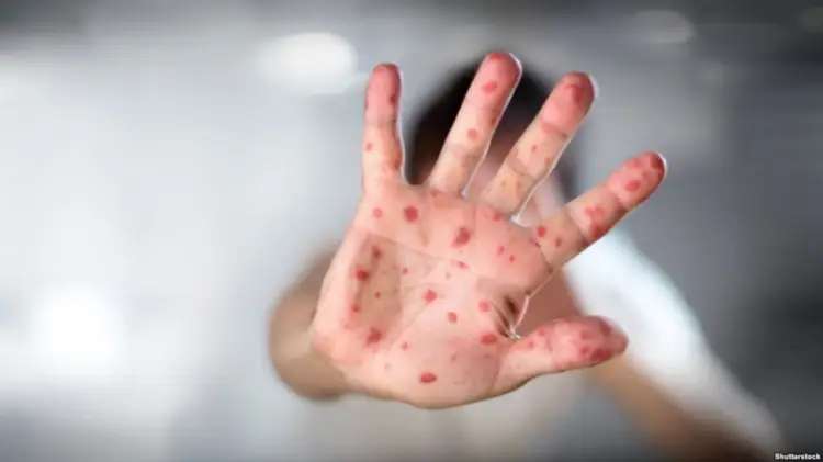 ОРВИ, корь: инфекционные стационары Астаны переполнены заразившимися детьми